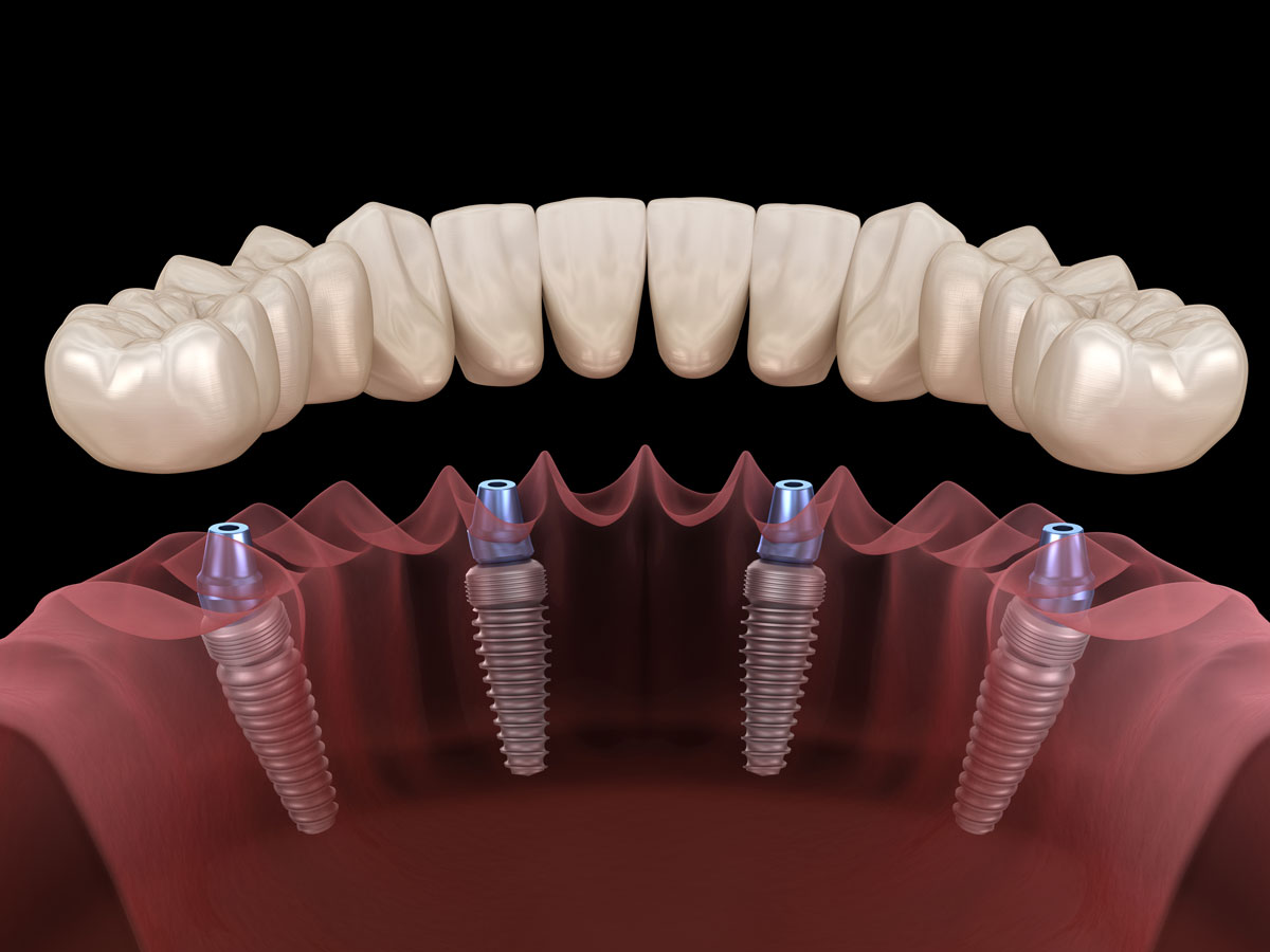 Impianti dentali ad Anagni