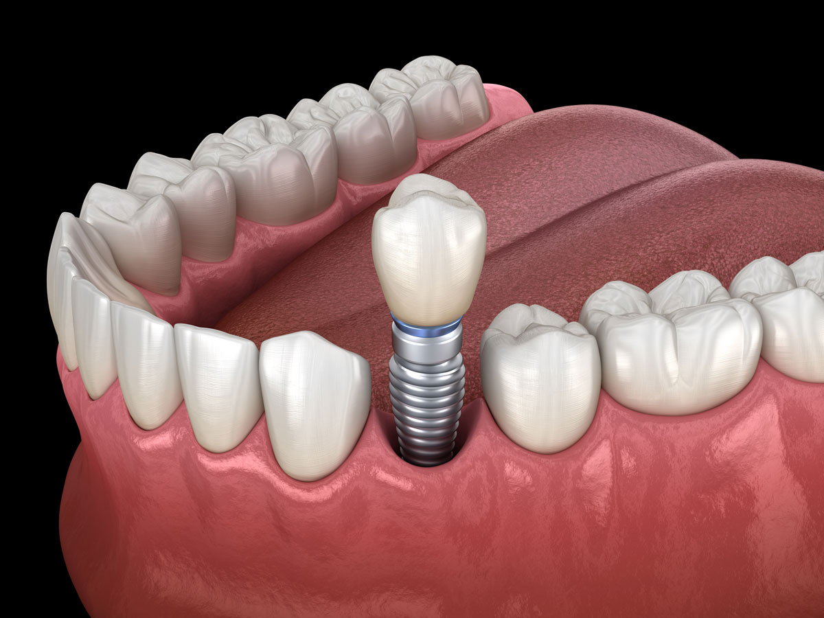 Impianti dentali ad Anagni