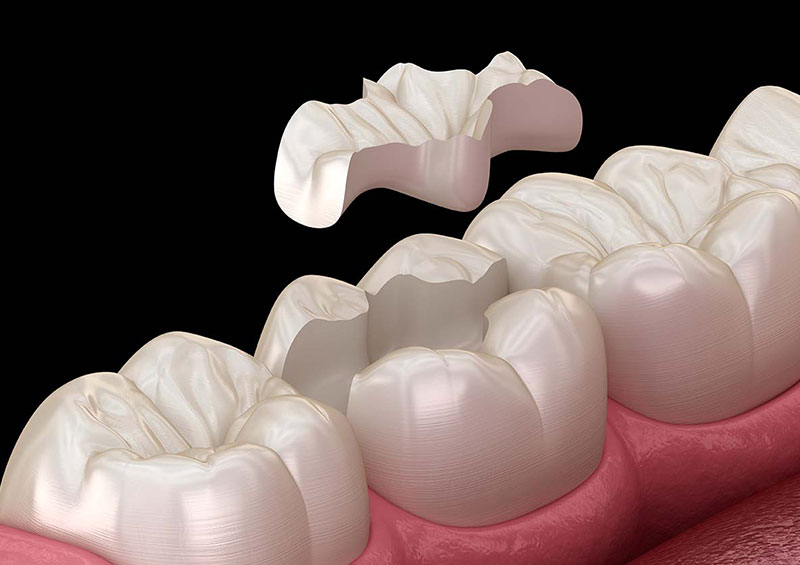 Rendering 3D di un intarsio dentale