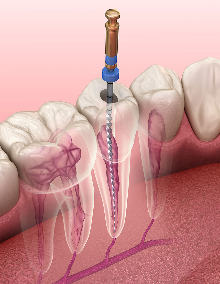 Render 3D del processo di endodonzia